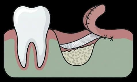 Augmentácia kosti, doplnenie kostného materiálu pred zavedením implantátu