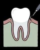 Prvá fáza: dentálna hygiena pred zavedením implantátu