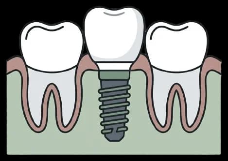 Zubný implantát ako náhrada chýbajúceho zuba bez zásahu do susedných zubov